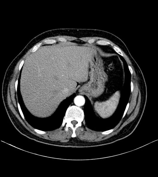 File:Clear cell renal cell carcinoma (Radiopaedia 85006-100539 B 19).jpg