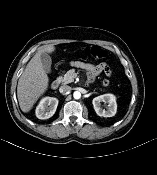 File:Clear cell renal cell carcinoma (Radiopaedia 85006-100539 B 33).jpg