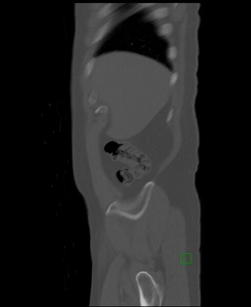 File:Clear cell renal cell carcinoma (Radiopaedia 85006-100539 Sagittal bone window 54).jpg