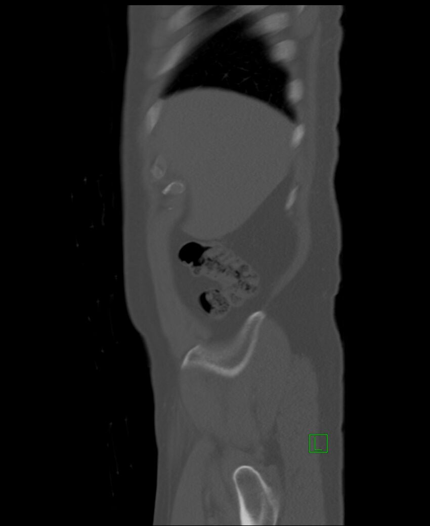 Clear cell renal cell carcinoma (Radiopaedia 85006-100539 Sagittal bone window 54).jpg
