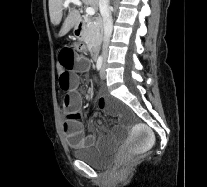 File:Closed loop small bowel obstruction (Radiopaedia 71211-81508 C 67).jpg