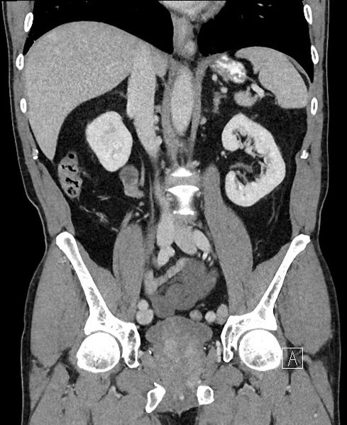 File:Closed loop small bowel obstruction - internal hernia (Radiopaedia 57806-64778 A 63).jpg