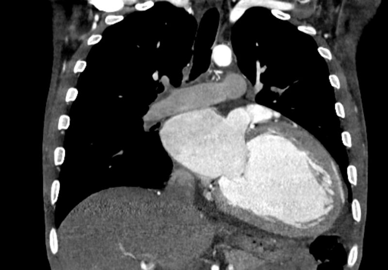 File:Coarctation of aorta with aortic valve stenosis (Radiopaedia 70463-80574 C 116).jpg