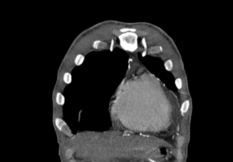 File:Coarctation of aorta with aortic valve stenosis (Radiopaedia 70463-80574 C 13).jpg