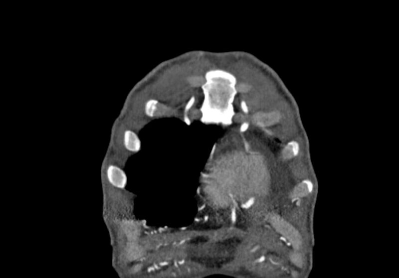 File:Coarctation of aorta with aortic valve stenosis (Radiopaedia 70463-80574 C 2).jpg