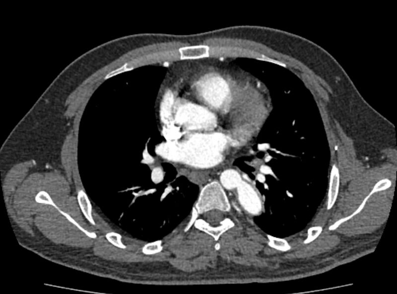 File:Coarctation of the aorta (Radiopaedia 53363-59343 A 24).jpg