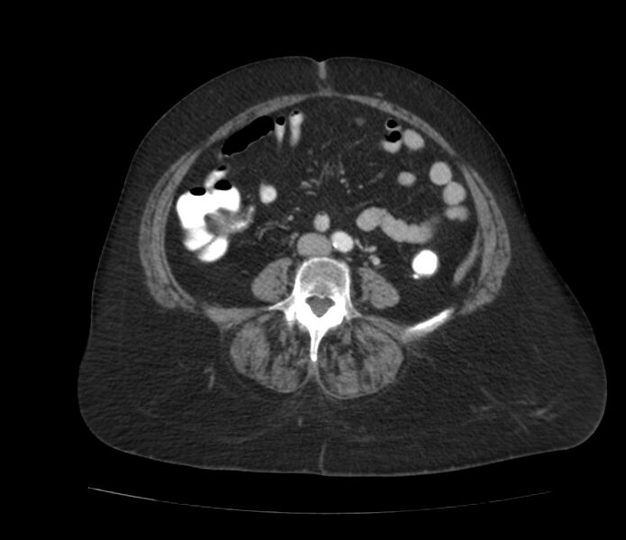 File:Colonic diverticulosis (Radiopaedia 22934-22957 A 43).jpg