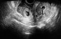 Heterotopic pregnancy (Radiopaedia 21216).jpg
