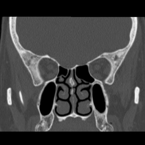File:Nasolabial cyst (Radiopaedia 33987-35205 Coronal bone window 43).jpg