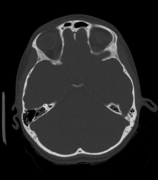 File:Nasoorbitoethmoid fracture (Radiopaedia 90044-107205 Axial bone window 89).jpg