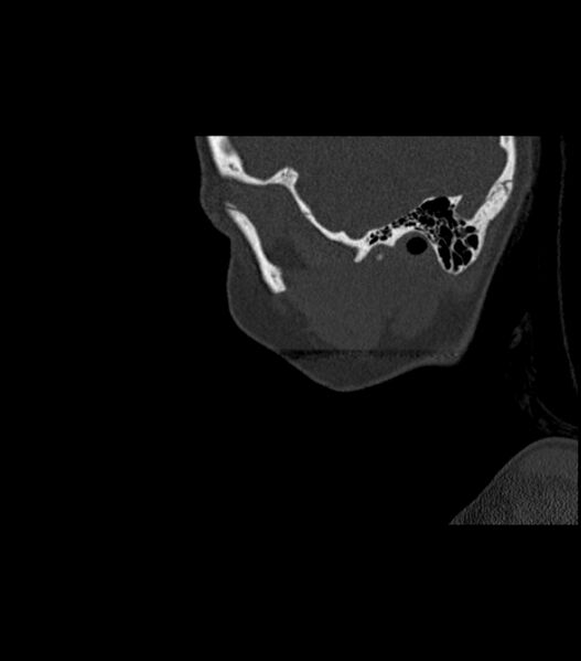 File:Nasoorbitoethmoid fracture (Radiopaedia 90044-107205 Sagittal bone window 123).jpg