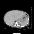 Neonatal neuroblastoma (Radiopaedia 56651-63438 Axial non-contrast 20).jpg
