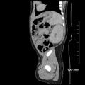 Neonatal neuroblastoma (Radiopaedia 56651-63438 C 25).jpg