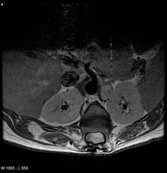 File:Neurofibromatosis type 2 - cranial and spinal involvement (Radiopaedia 5351-7112 Axial T1 C+ 4).jpg