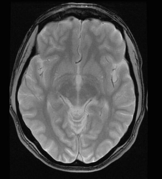 File:Neurosarcoidosis (Radiopaedia 11674-12037 Axial Gradient Echo 1).jpg