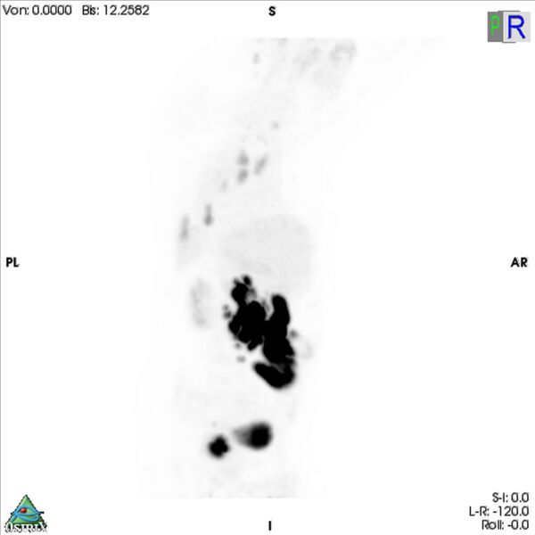 File:Non-Hodgkin lymphoma involving seminal vesicles with development of interstitial pneumonitis during Rituximab therapy (Radiopaedia 32703-33675 PET cor 3D MIP 9).jpg