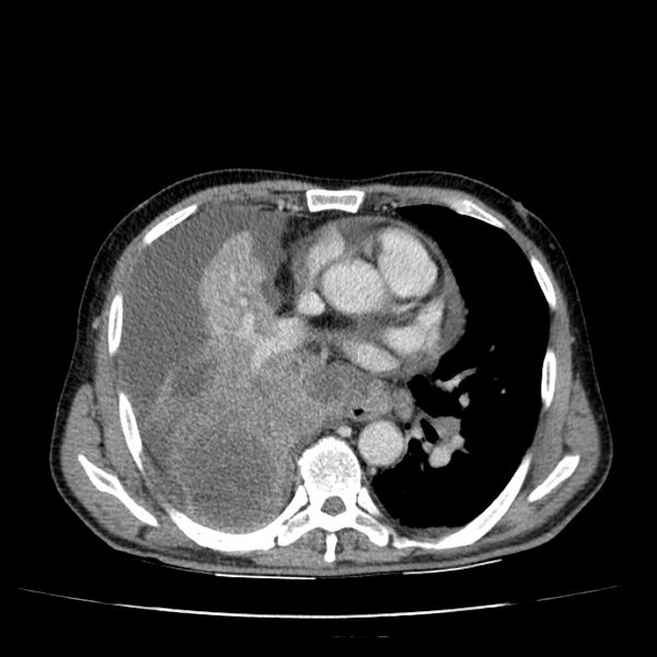 File:Non small-cell lung cancer (Radiopaedia 24467-24769 C+ delayed 33).jpg