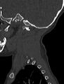 Normal CT cervical spine - pediatric (Radiopaedia 52549-58462 Sagittal bone window 200).jpg