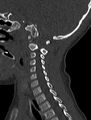 Normal CT cervical spine - pediatric (Radiopaedia 52549-58462 Sagittal bone window 68).jpg
