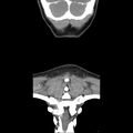 Normal CT of the neck (Radiopaedia 14575-14500 Coronal C+ 49).jpg
