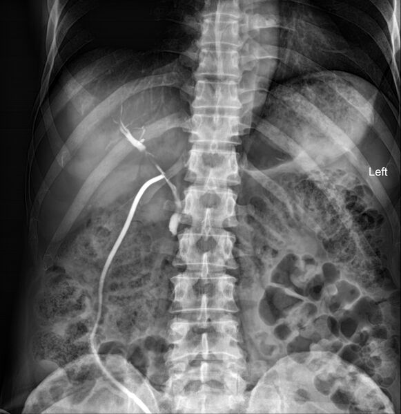 File:Normal T-tube cholangiography (Radiopaedia 91953-109789 B 1).jpg