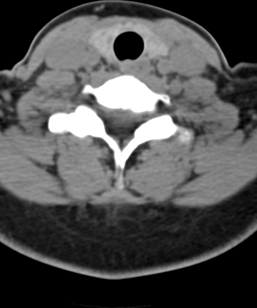 File:Normal cervical spine MRI (including Dixon) (Radiopaedia 42762-45926 Axial non-contrast 45).png