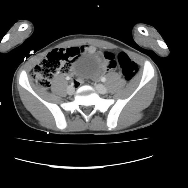 File:Normal dual-phase trauma CT chest,abdomen and pelvis (Radiopaedia 48092-52899 A 90).jpg