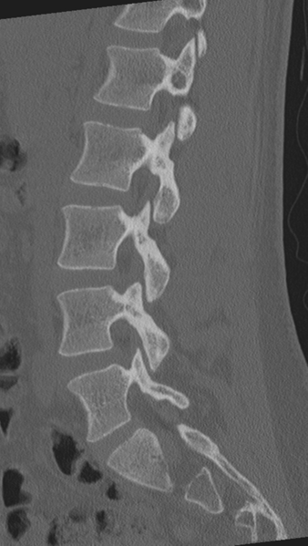 File:Normal lumbar spine CT (Radiopaedia 46533-50986 Sagittal bone window 60).png