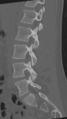 Normal lumbar spine CT (Radiopaedia 46533-50986 Sagittal bone window 60).png