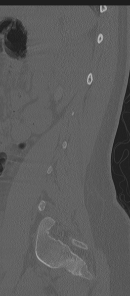File:Normal lumbosacral CT (Radiopaedia 37923-39867 Sagittal bone window 22).png