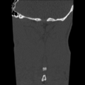 Normal trauma cervical spine (Radiopaedia 41017-43760 Coronal bone window 43).png