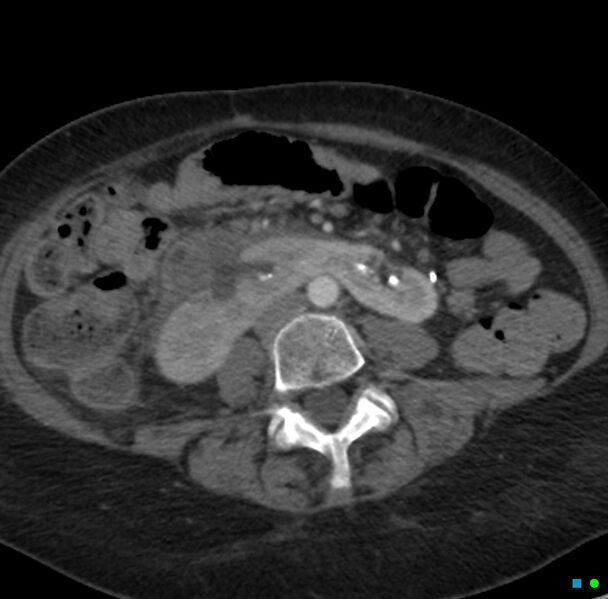 File:Obstructed infected horseshoe kidney (Radiopaedia 18116-17898 B 20).jpg