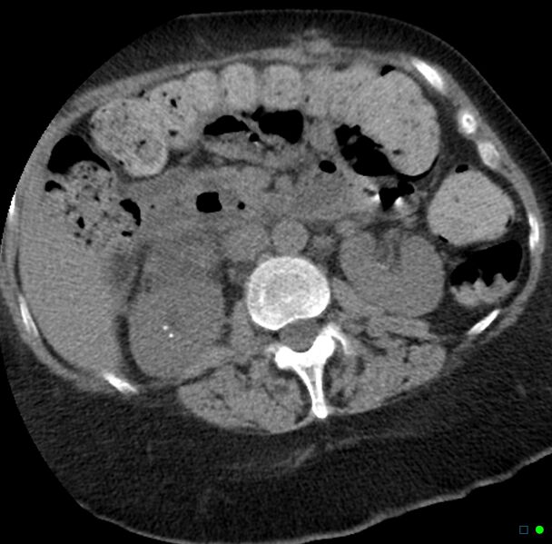 File:Obstructed infected horseshoe kidney (Radiopaedia 18116-17898 non-contrast 8).jpg