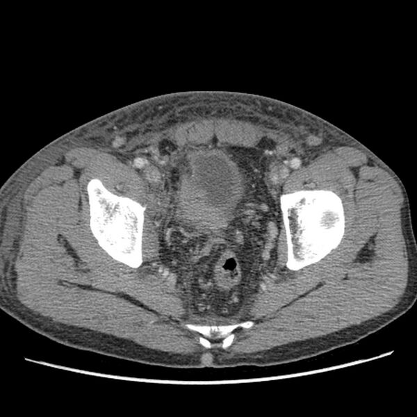 File:Obstructive bladder transitional cell carcinoma (Radiopaedia 9825-10410 A 30).jpg
