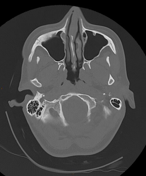 File:Occipital condyle fracture (Radiopaedia 61165-69056 Axial bone window 22).jpg