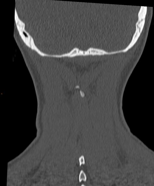 File:Occipital condyle fracture (Radiopaedia 61165-69056 Coronal bone window 1).jpg