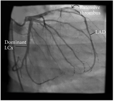 Angiographic image showing extensive LAD thrombosis