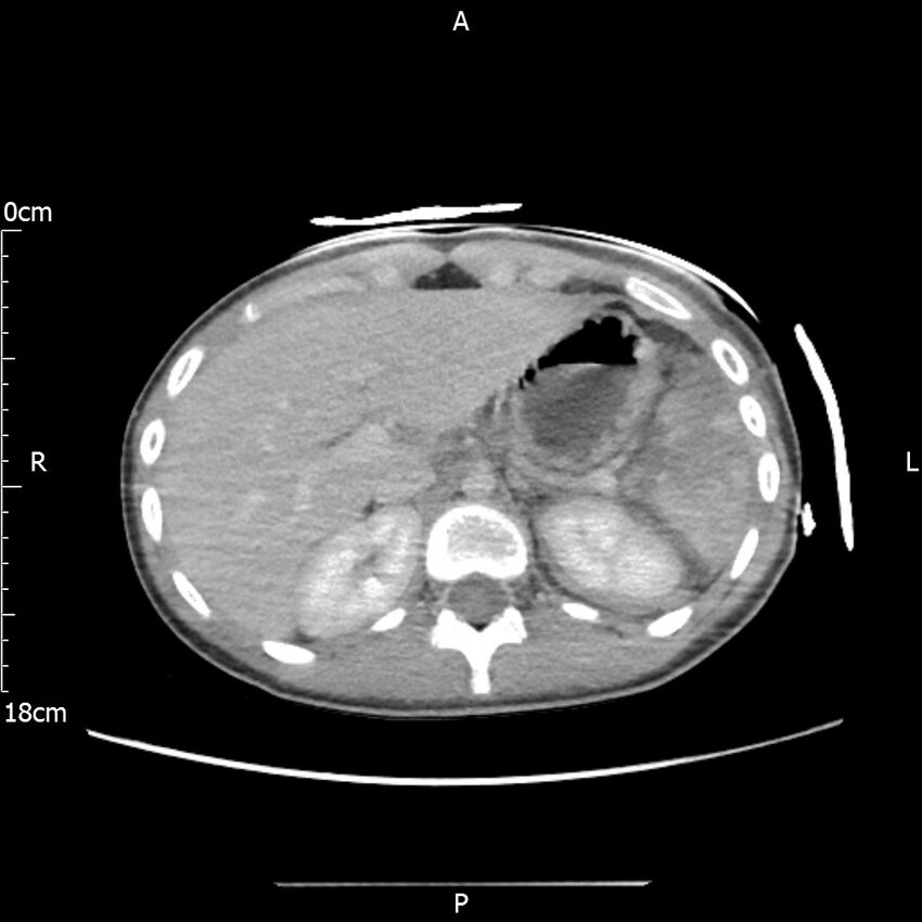 AAST grade IV kidney injury with CEUS follow-up (Radiopaedia 72353-82877 Axial C+ portal venous phase 16).jpg