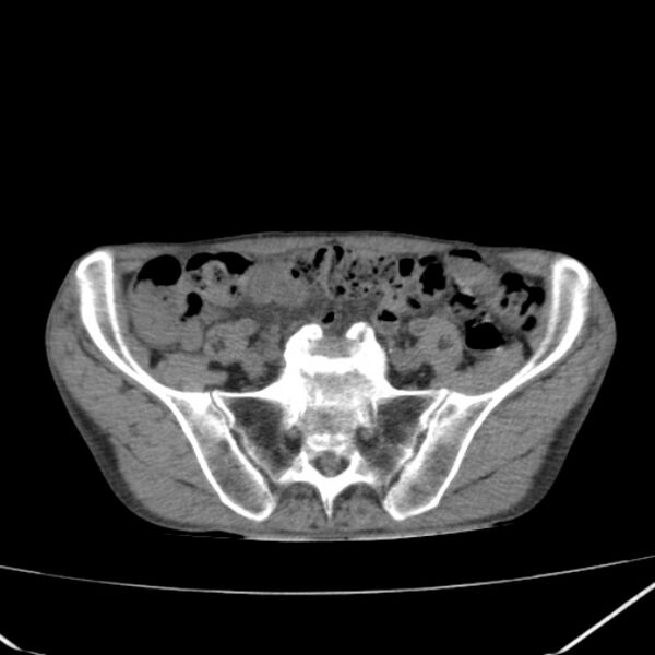 File:Abdominal aortic aneurysm (Radiopaedia 23703-23856 Axial non-contrast 43).jpg