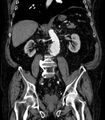Abdominal aortic aneurysm (Radiopaedia 25855-26001 Coronal C+ arterial phase 41).jpg