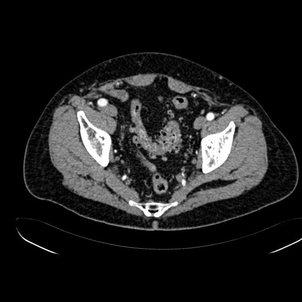 File:Abdominal aortic aneurysm (Radiopaedia 75131-86203 Axial C+ arterial phase 41).jpg