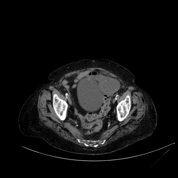 File:Abdominal aortic aneurysm - impending rupture (Radiopaedia 19233-19246 Axial non-contrast 107).jpg