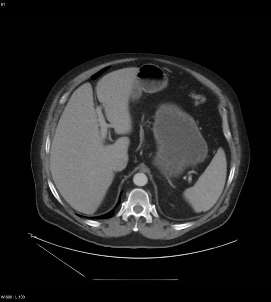 File:Abdominal aortic aneurysm with intramural hematoma then rupture (Radiopaedia 50278-55631 Axial C+ arterial phase 52).jpg