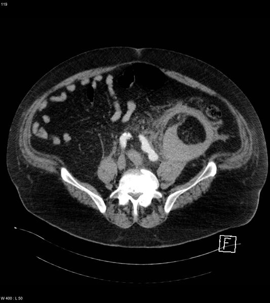 File:Abdominal aortic aneurysm with intramural hematoma then rupture (Radiopaedia 50278-55632 Axial C+ arterial phase 118).jpg