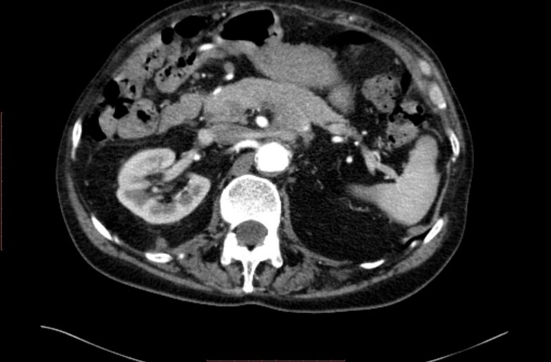 File:Abdominal aortic interposition tube graft and aneurysm thrombosis (Radiopaedia 71438-81857 Axial C+ arterial phase 33).jpg