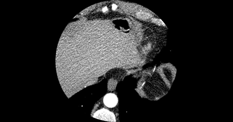 File:Aberrant left main coronary artery (ALMCA) arising from the right sinus with interarterial course (Radiopaedia 63251-71814 Axial C+ arterial phase 189).JPG