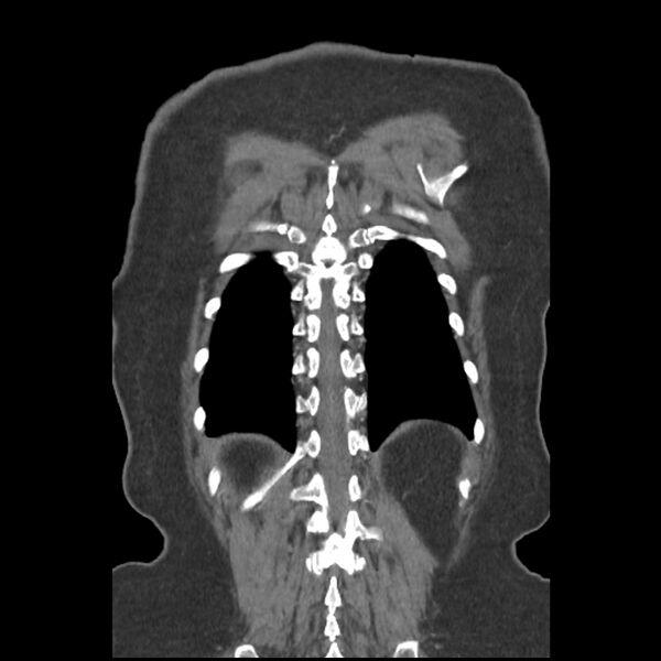 File:Aberrant right subclavian and left vertebral arteries (Radiopaedia 43467-46847 Coronal C+ portal venous phase 76).jpg