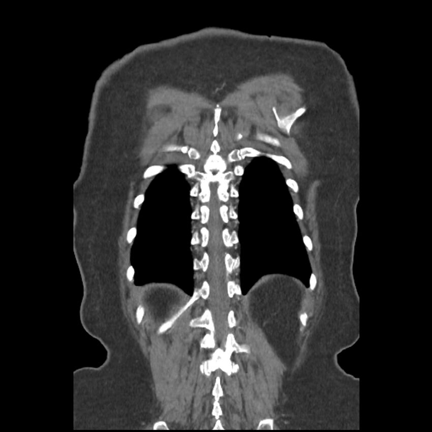 Aberrant right subclavian and left vertebral arteries (Radiopaedia 43467-46847 Coronal C+ portal venous phase 76).jpg