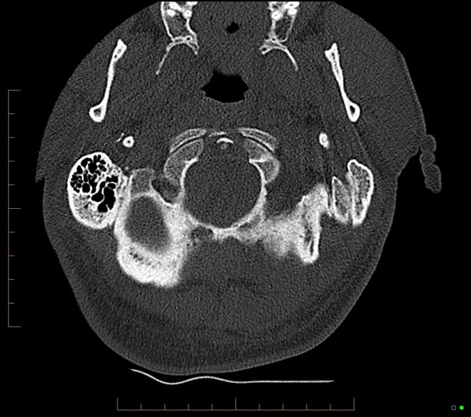 File:Accessory articulation of cervical transverse processes (Radiopaedia 82715-96933 Axial non-contrast 8).jpg