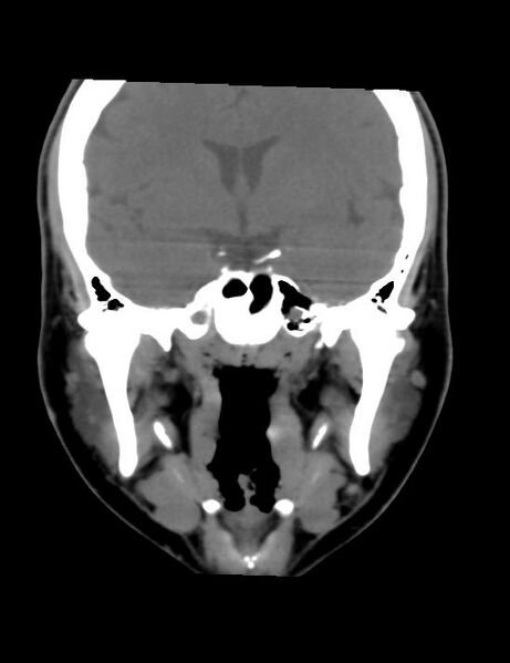 File:Accessory parotid glands (Radiopaedia 27289-27472 Coronal non-contrast 9).jpg